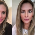 Can Botox Injections Go Wrong? - An Expert's Perspective