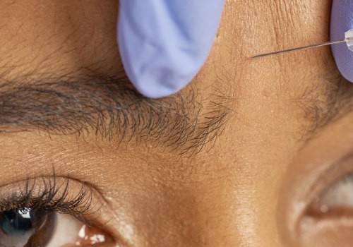 What Do Botox Injections Do? A Comprehensive Guide